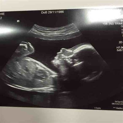 sydney ultrasound dating scan